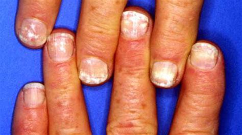 7 Causes of White Nail Spots (And When It's Serious) .
